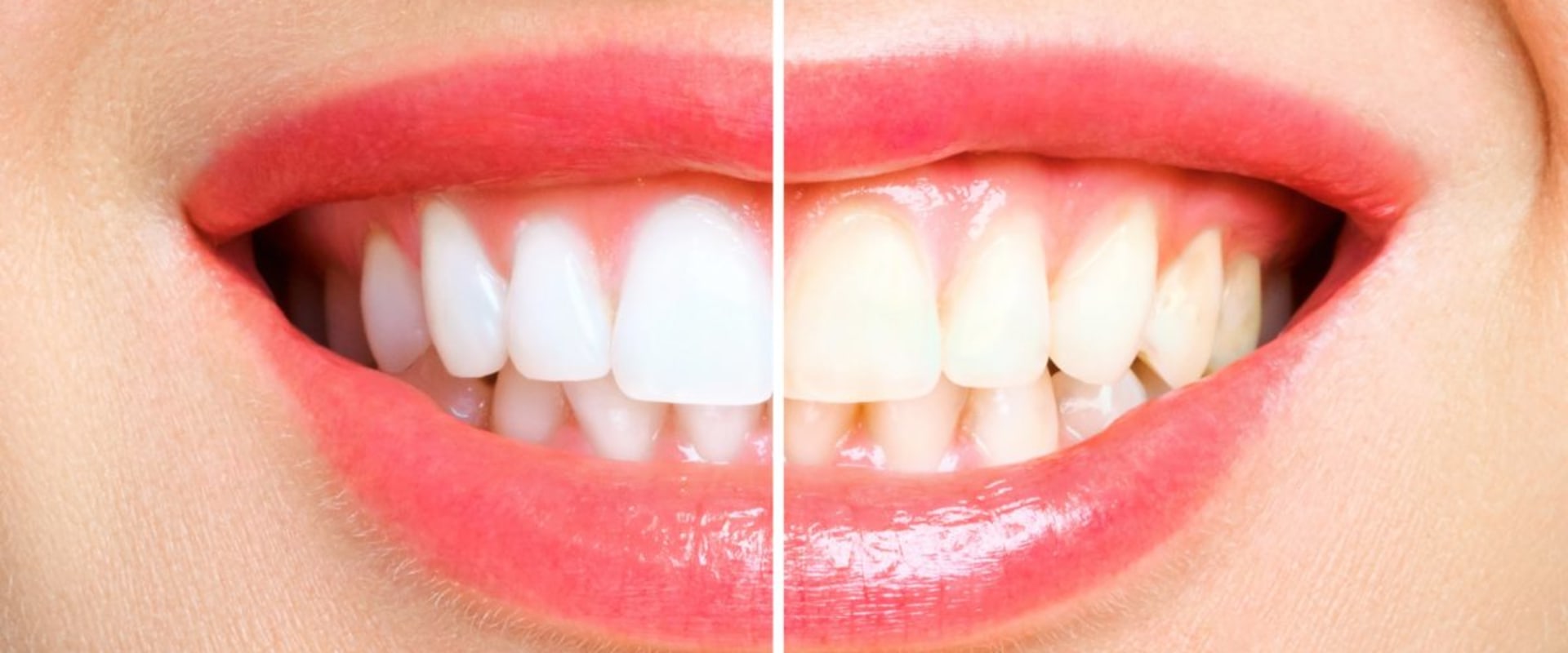 How Diet Influences the Teeth Whitening Best Method