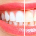 How Diet Influences the Teeth Whitening Best Method
