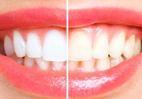 How Diet Influences the Teeth Whitening Best Method